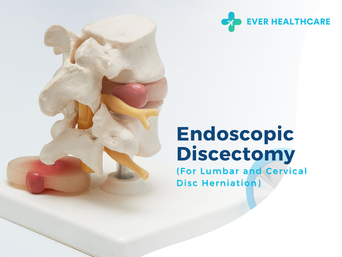 Endoscopic Discectomy for Lumbar and Cervical Disc Herniation in